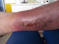 Leg ulcer.jpg